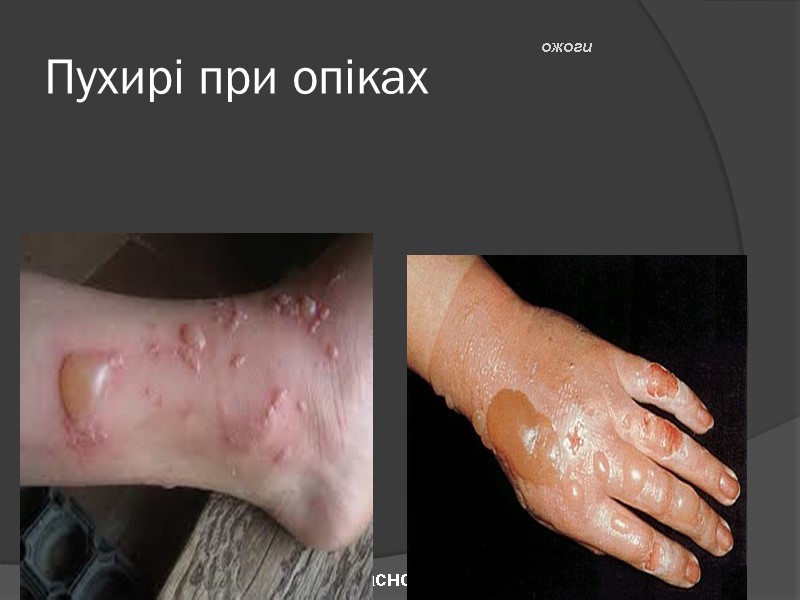 Пухирі при опіках